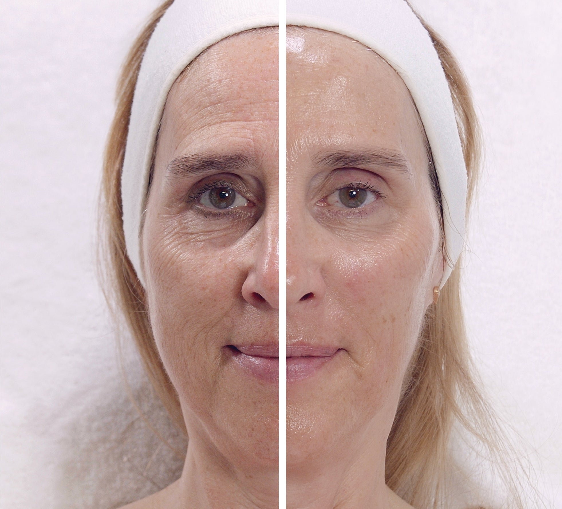 World Exclusive: Visible Age Reverse Treatment